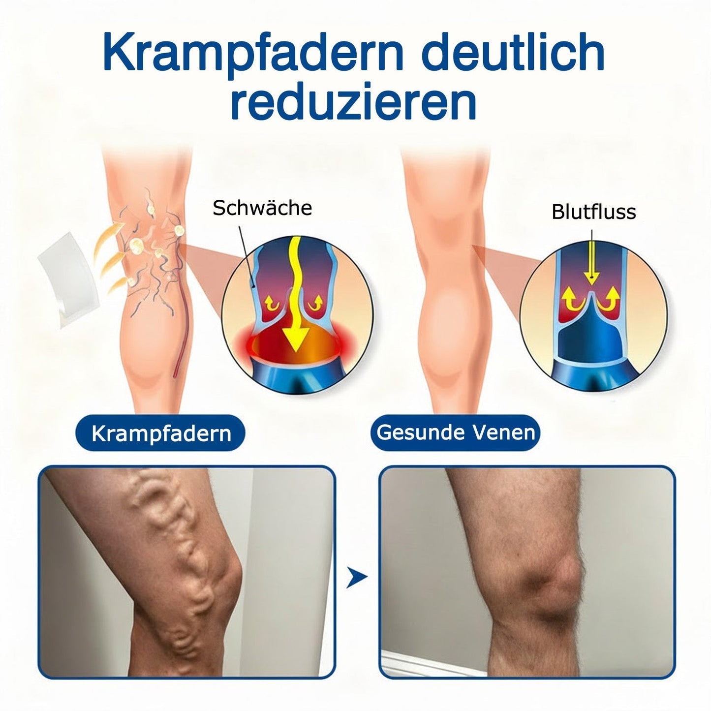 👨🏼‍⚕️✅GFOUK® VeinTarget Mikronadel-Pflaster⚡Sofortige Linderung, Langzeit-Ergebnisse