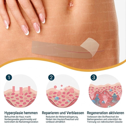 👨🏼‍⚕️✅Offizieller Shop | Ourlyard® Hyaluronsäure Mikronadel-Tape (Behandelt alle Arten von Narben, Dehnungsstreifen, Akne, Verbrennungen, Warzen und Krampfadern)