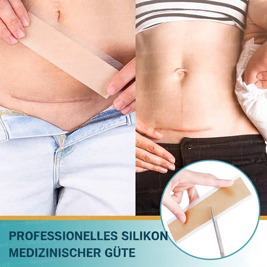 👨🏼‍⚕️✅Offizieller Shop | Ourlyard® Hyaluronsäure Mikronadel-Tape (Behandelt alle Arten von Narben, Dehnungsstreifen, Akne, Verbrennungen, Warzen und Krampfadern)