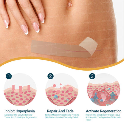 ❤︎Official Store |Ourlyard® Hyaluronsäure Nano Microneedle Repair Tape🗽🎉(Behandlung von alten und neuen Narben, Reduzierung von chirurgischen Narben, Dehnungsstreifen, Keloiden, Akne, Verbrennungen, Warzen, Dermatome und Krampfadern) (Upsell)